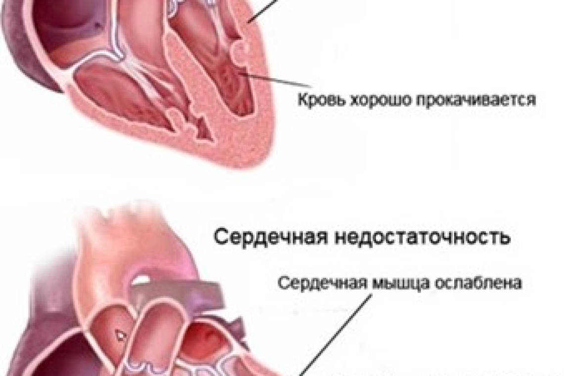 С 1 по 7 мая во всех регионах Казахстана проходит неделя ХСН (Хроническая сердечная недостаточность).